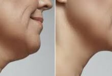 Double Chin Removal in Dubai