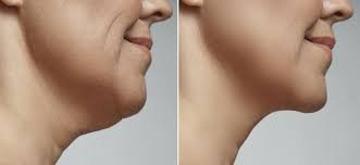Double Chin Removal in Dubai