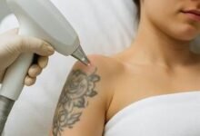 Tattoo removal: Why timing and skin analysis are crucial for success