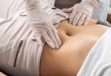 Is a Tummy Tuck in Dubai Worth Considering for a Flatter Abdomen?