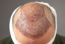 How does lifestyle affect hair transplant results after 10 years?