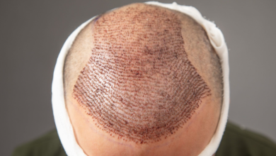 How does lifestyle affect hair transplant results after 10 years?