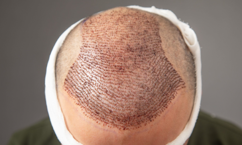 How does lifestyle affect hair transplant results after 10 years?